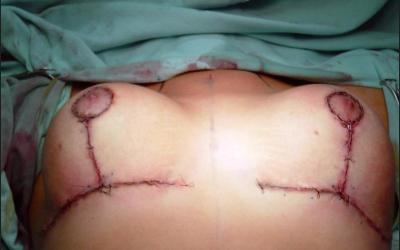 Paciente será indenizada por cicatrizes anormais
